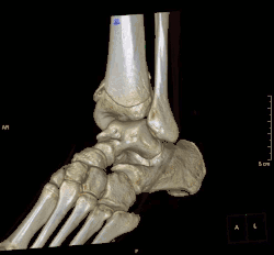 Vidíme spodní část holenní kosti vraženou do odlomené hlavice