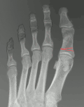 Hallux valgus (rtg. kombinace lečení)