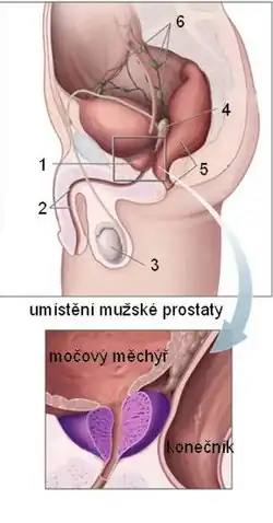 Umístění prostaty: 1. prostata, 2. močová trubice, 3. varle, 4. semenný váček, 5. konečník, 6. mízní uzliny