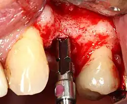 Série pomaloběžných vrtáků vytvoří a postupně zvětšuje místo v čelisti pro umístění implantátu. Otvor se nazývá osteotomie.