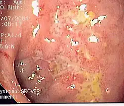 Endoskopický snímek vývoje Crohnovy nemoci v oblasti tlustého střeva