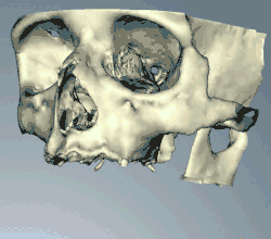 Snímky z výpočetní tomografie lze načíst do softwaru CAD/CAM a vytvořit simulaci požadovaného ošetření. Na základě těchto dat se pak umístí virtuální implantáty a na 3D tiskárně se vytvoří stent.