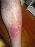 Cellulitis holeně