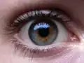 Centrální heterochromie