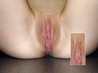 Předkožka klitorisu