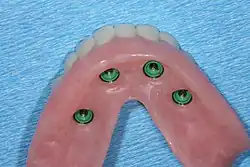 Pouzdro pro dolní zubní náhradu s implantáty