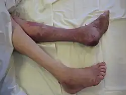 končetina postižená crush syndromem