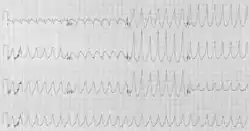 EKG pacienta s tachykardií