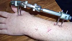 zevní fixace zlomeniny horní končetiny