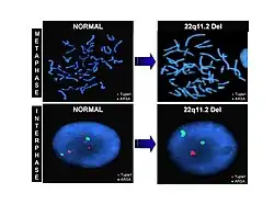 FISH analýza pacienta s DG