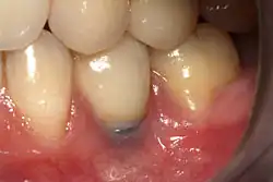 Ukázka implantátů