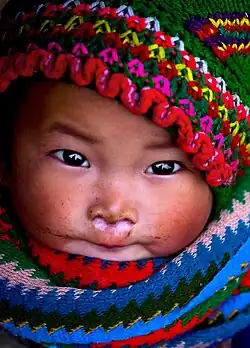 Hmongská dívenka trpící rýmou