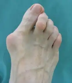 Hallux valgus (před operací)