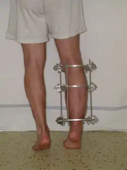 Ilizarevův fixátor − Léčba zlomeniny ve Fakultní nemocnici Ostrava