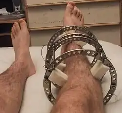Ilizarevův fixátor (příklad zevní fixace) − léčba zlomeniny tibie