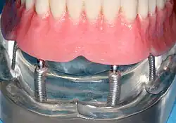Overdenture s implantáty