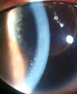 Zánět oka a keratické precipitáty způsobené uveitidou