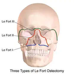 Le Fortovy osteotomie