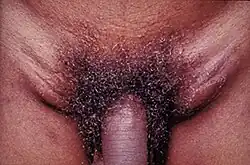 LGV u muže ve stádiu zduření uzlin