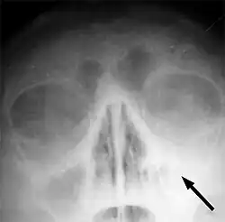 RTG snímek v semiaxiální projekci - sinusitida levé čelistní (maxilární) dutiny. Na snímku je patrné zastření levé (tedy na pravé straně snímku ležící) dutiny podmíněné nahromaděním tekutiny