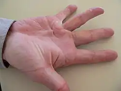 Ruka s Dupuytrenovou kontrakturou u prsteníčku