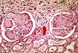 diabetická glomeruloskleróza