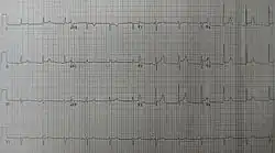 Změny na EKG u perikarditidy: elevace ST úseku v hrudních svodech a reciproční deprese ST úseku ve svodu aVR
