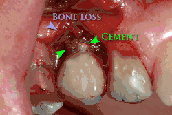 Periimplantitida způsobená cementem