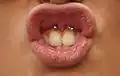 Frenulum či Smiley