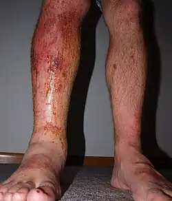 Popáleniny a otok způsobené jedovatcem kořenujícím (urushiolem)