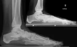 Aplikace Hintermannovy osteotomie