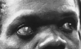 Pacient s říční slepotou