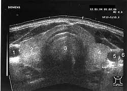 USG štítné žlázy: 1 a 5: krkavice, 2 a 4: štítná žláza, 3: průdušnice , 6: hrdelní žíla