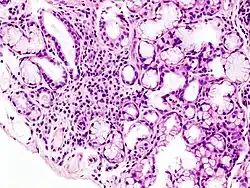 Histopatologický snímek fokální lymfoidní infiltrace malé slinné žlázy při Sjögrenově syndromu; biopsie rtu