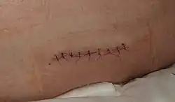 Stehy s chirurgickou nití