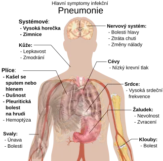 A diagram of the human body outlining the key symptoms of pneumonia