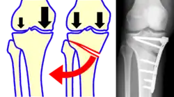 Osteotomie tibie