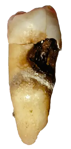 Zubní kaz v oblasti krčku