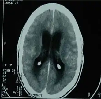 Tomografický snímek ukazující tuberkulózní zánět mozkových blan