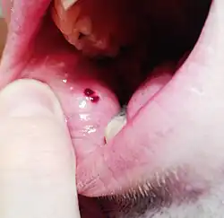 Vyrážka, která se může citlivým osobám udělat jakožto následek alergické reakce (například i po požití většího množství žvýkacích bonbonů)