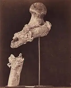 Zlomená stehenní kost poručíka Goodwina, 7 měsíců po zranění střelou, 1865