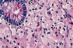 Mikroskopický snímek tenkého střeva u Whippleovy choroby: v lamina propria je přítomný infiltrát zpěněných makrofágů